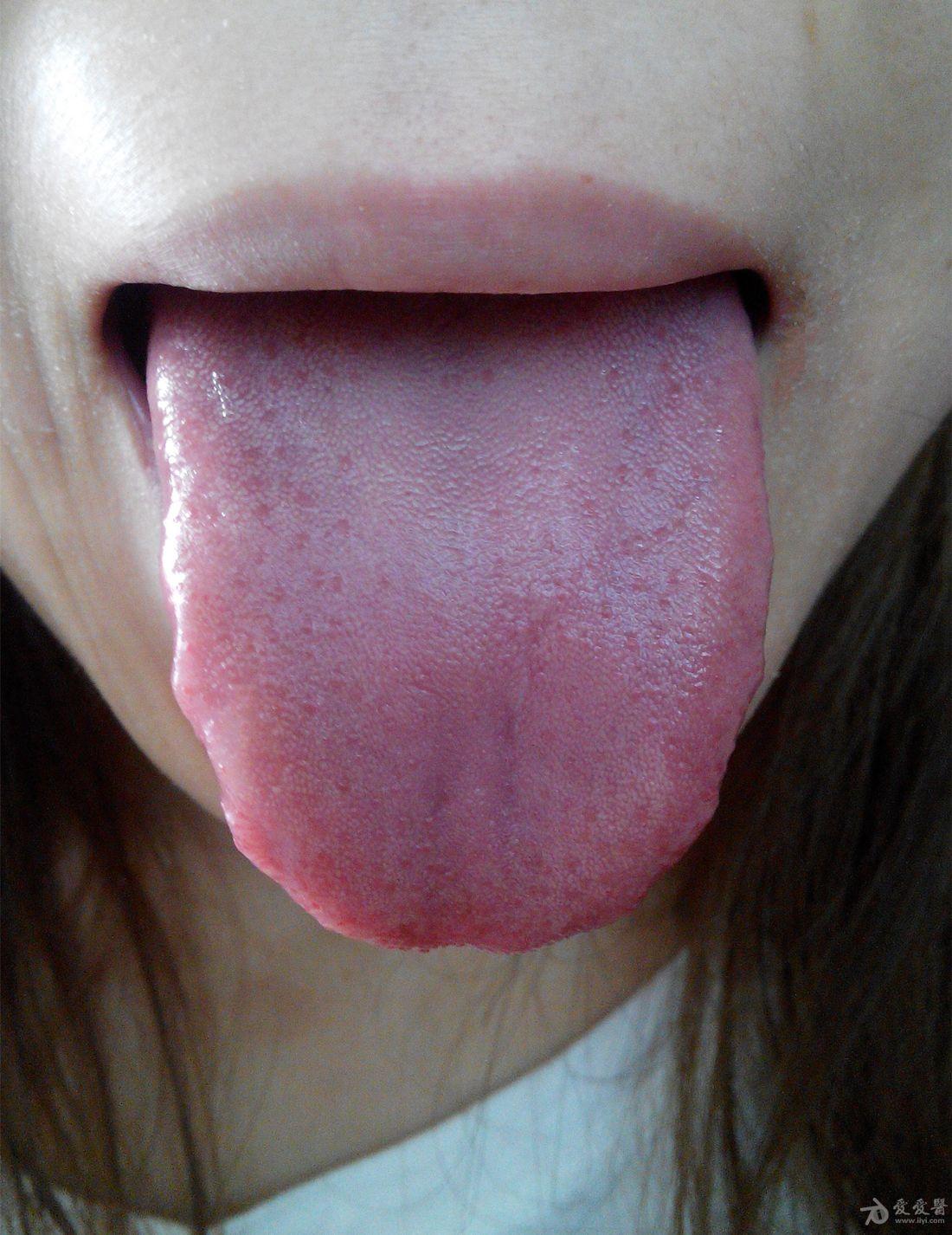 我有湿疹,谁能帮看下舌头看是不是脾虚?