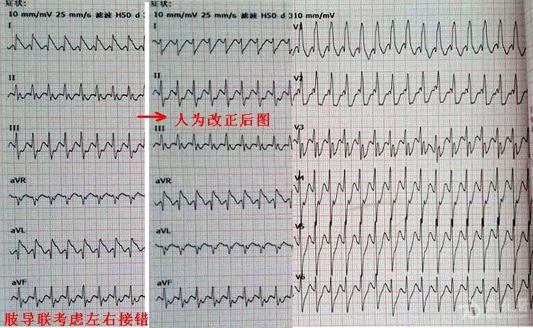 这是左右手纠正后图.