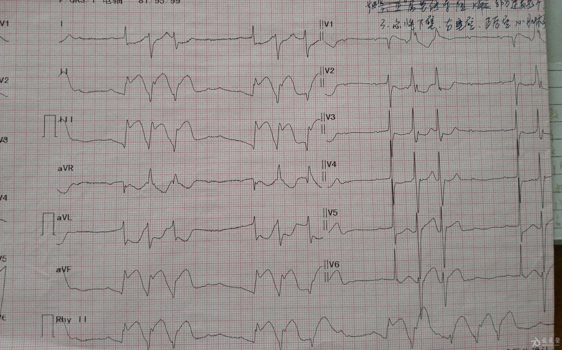 心梗电除颤前后请帮分析一下谢谢