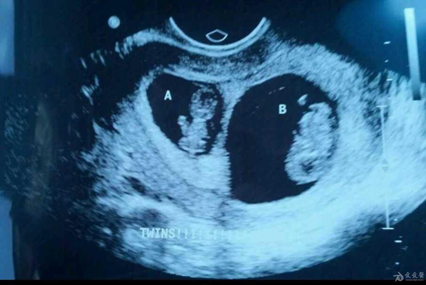 35岁孕妇怀了一对双胞胎,这看上去像正常双胞胎的大小吗?