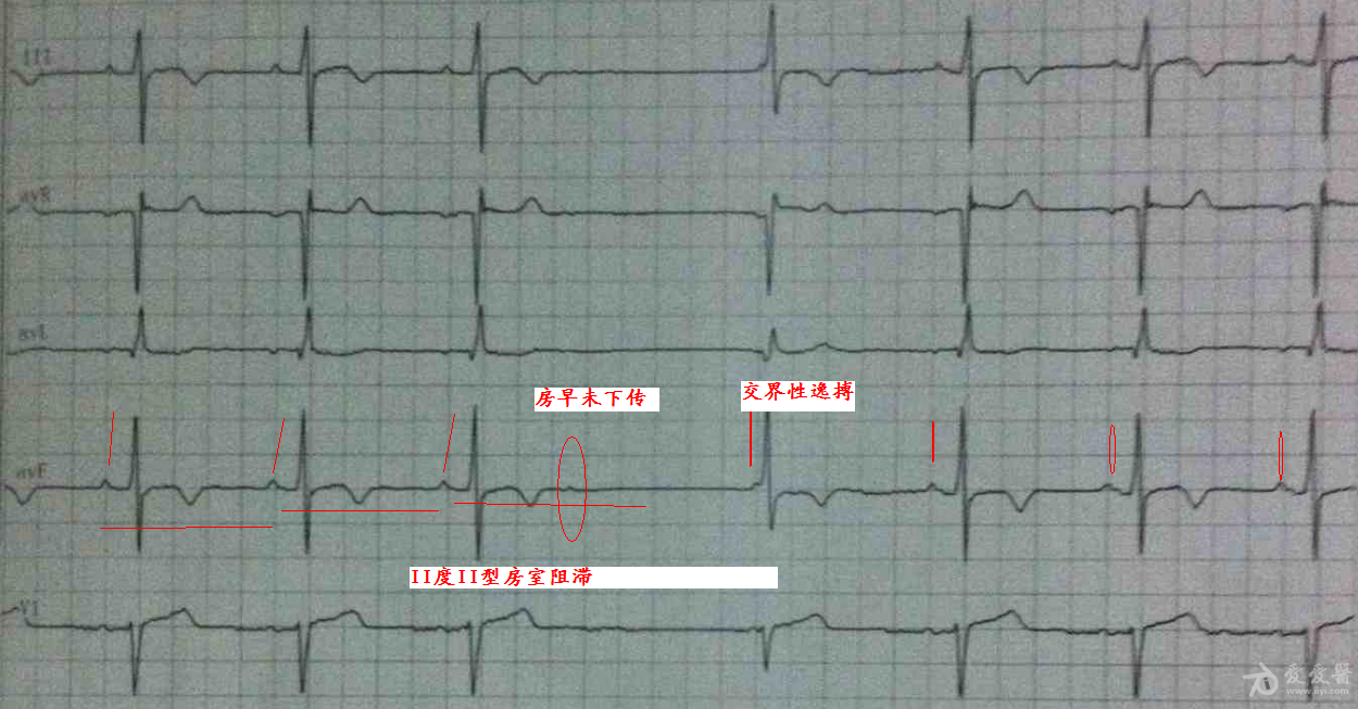 二度2型房室传导阻滞