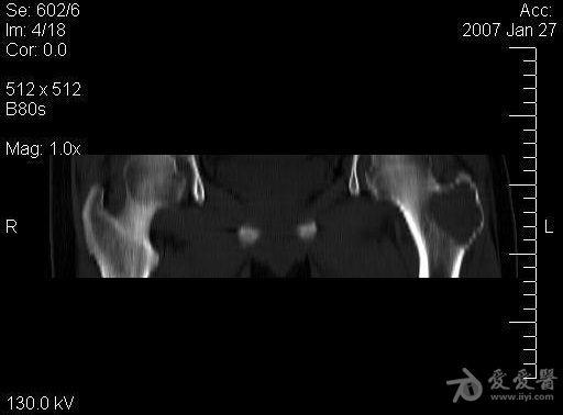 经典病例股骨大转子软骨母细胞瘤一例