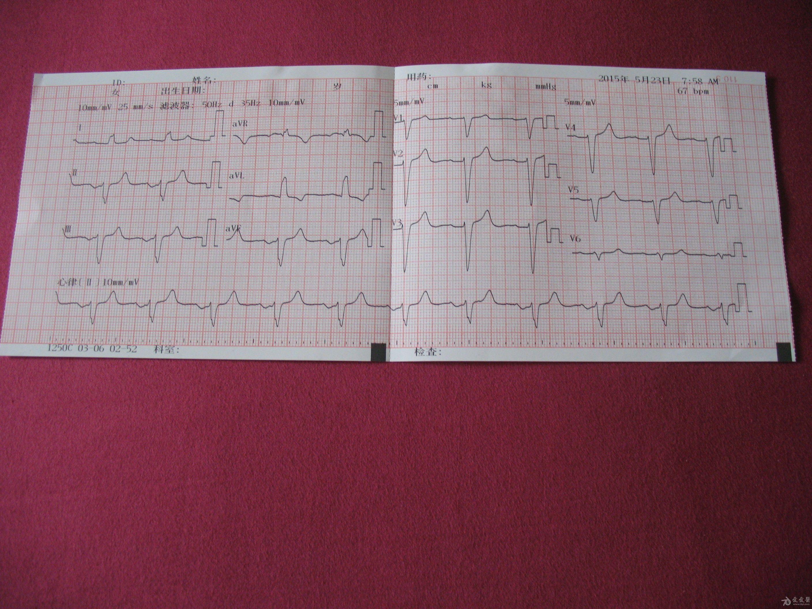 体检心电图 - 心电图脑电图专业讨论版 - 爱爱医医学