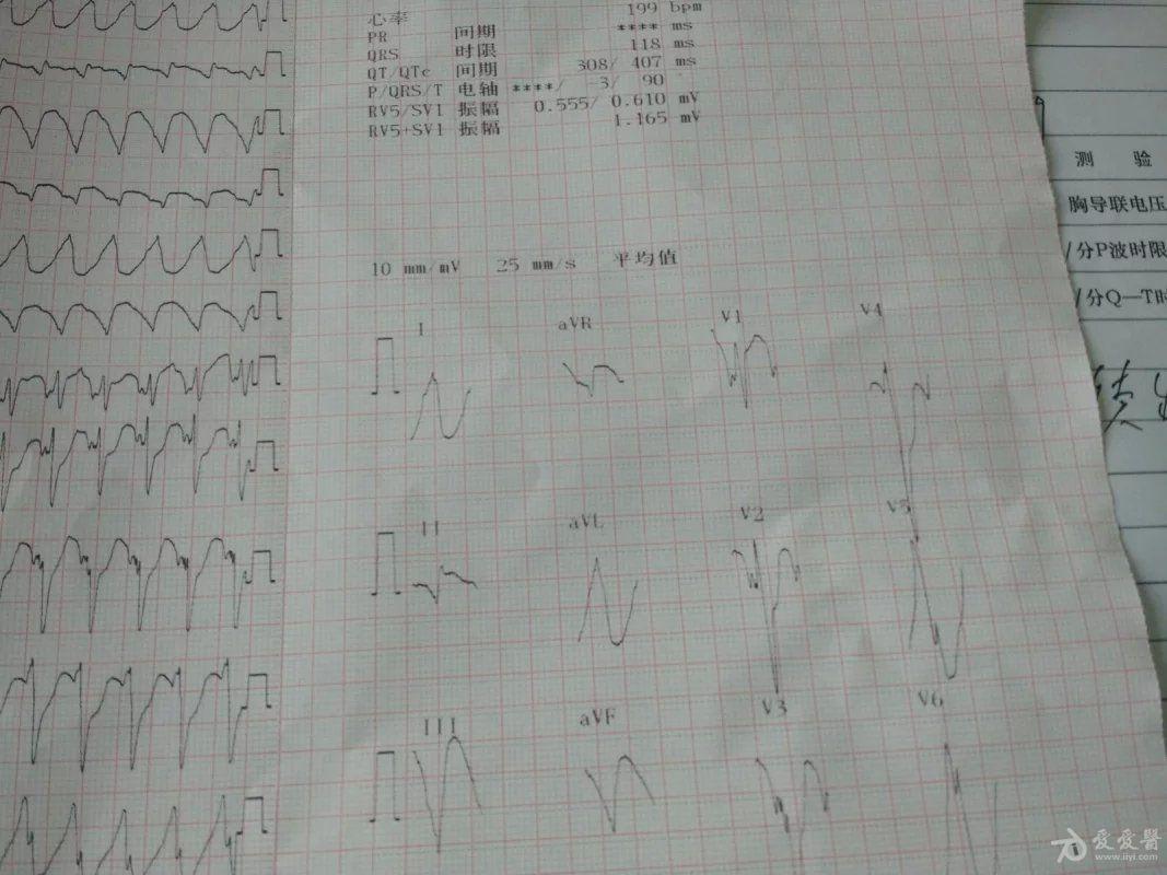 心衰- 心电图脑电图专业讨论版 - 爱爱医医学论坛