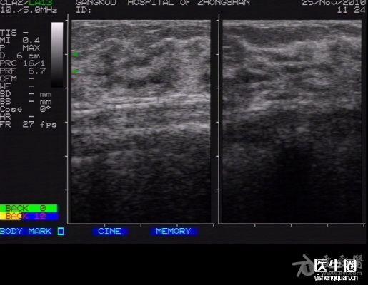 求一张增生的乳腺图片都这么难? - 超声医学讨论版 - 爱爱医医学论坛