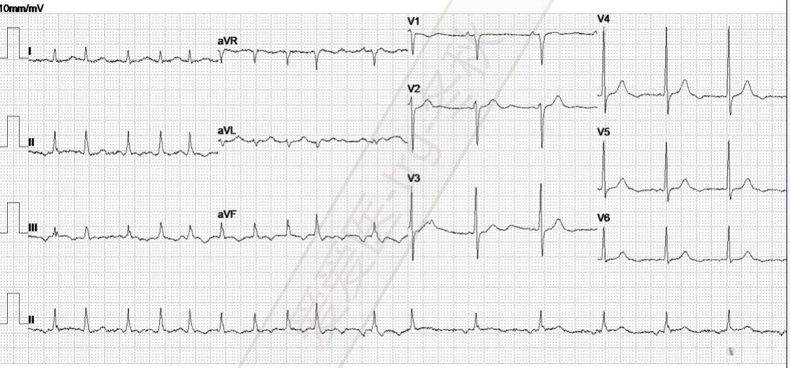 冬秋-心电图讨论20150618-p波倒置