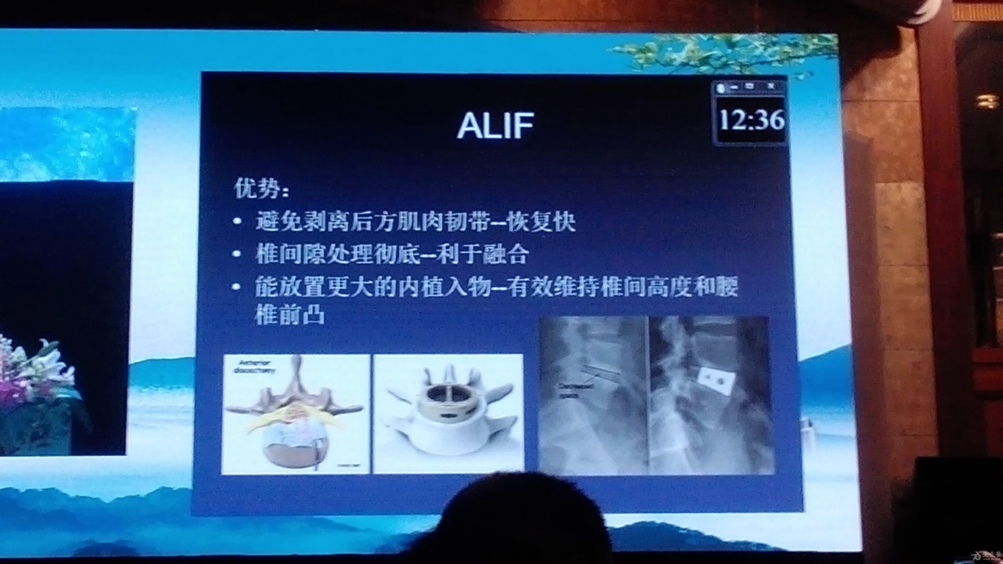 plf/plif/tlif/alif/xlif 区别