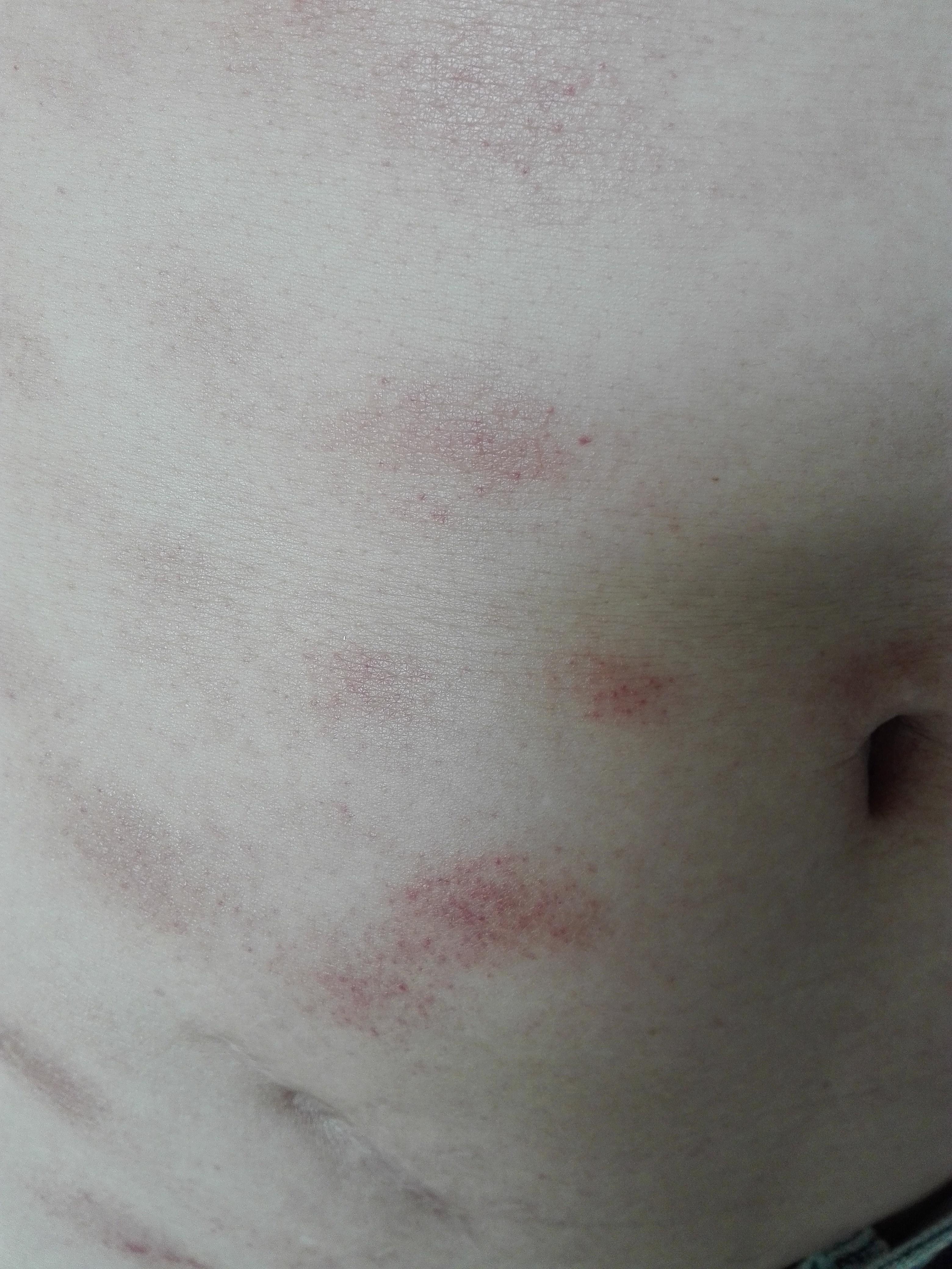 一个多月病史胸腹部斑疹如下图斑上面没有鳞削不痛不痒这个是不是玫瑰