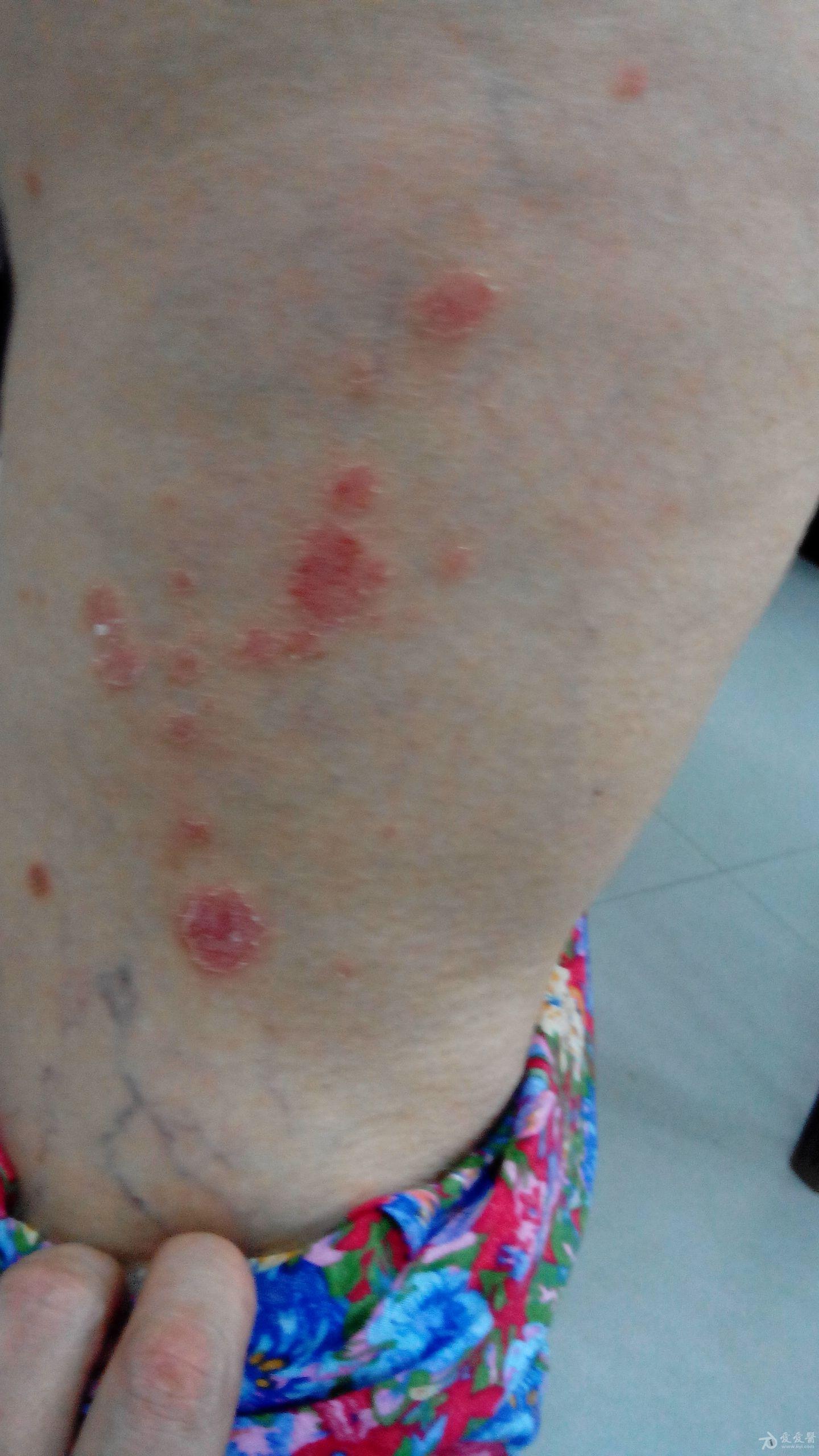 看图识病是不是玫瑰糠疹