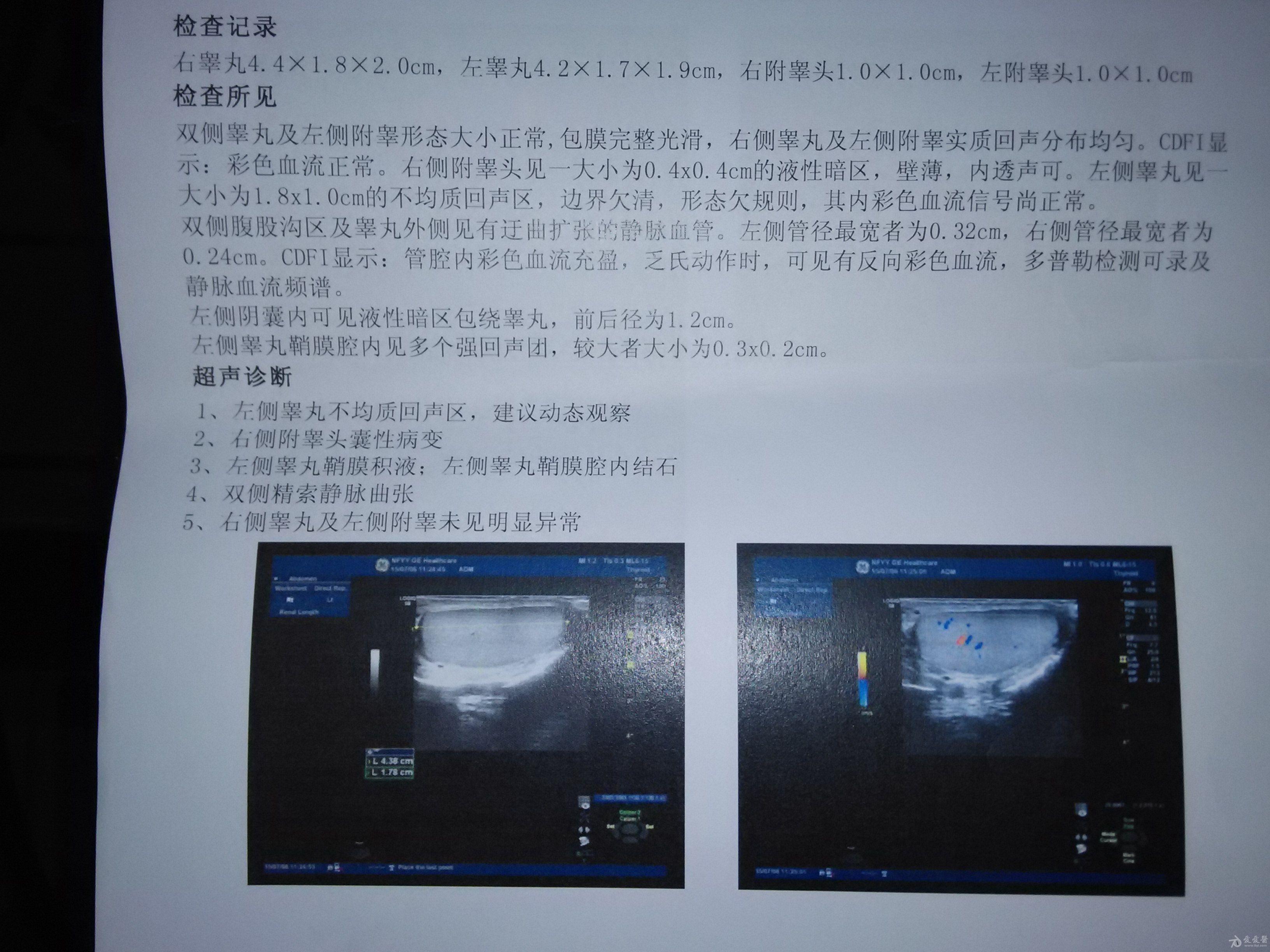 左侧睾丸不均质回声区右侧附睾头囊性病变请问医生我这睾丸的情况需