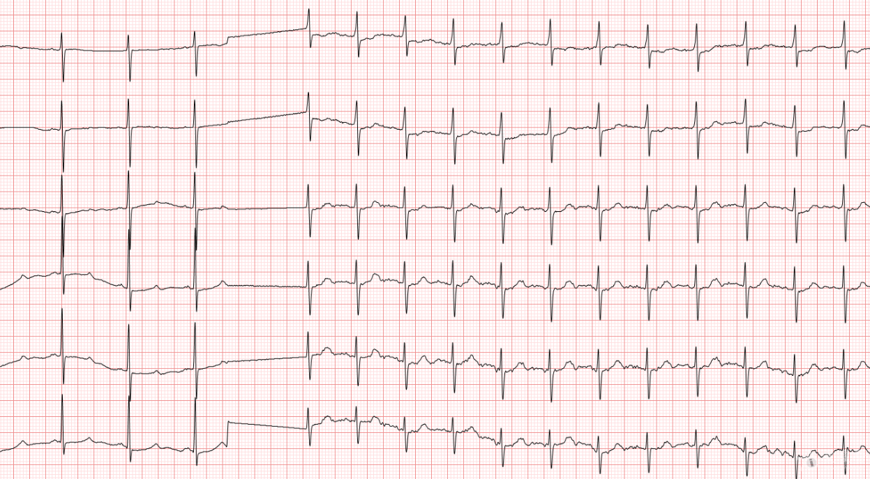 冬秋-心电图讨论-20150720-心动过速是什么性质