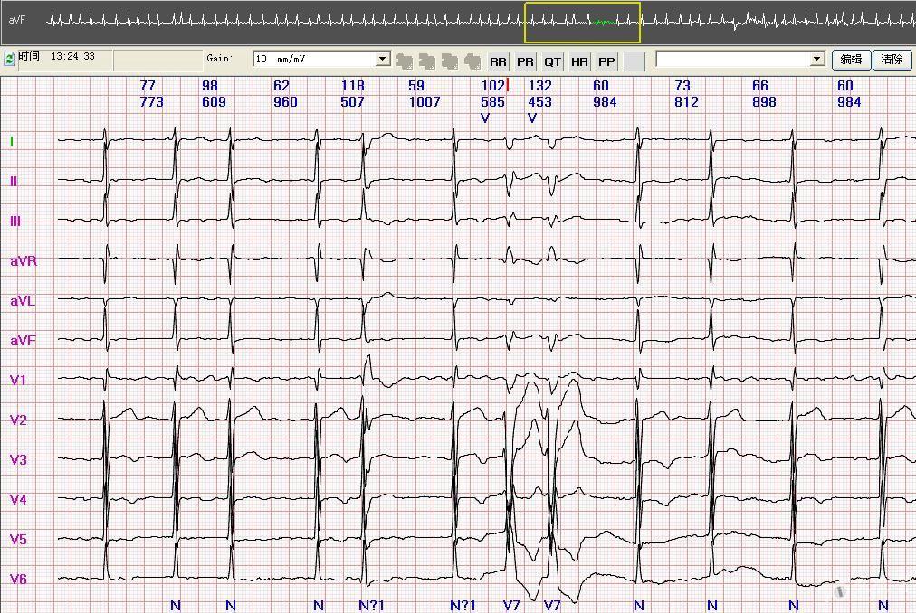 [心律失常] 一例持续房颤的动态心电图