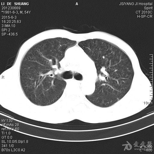 大家考虑什么,我下尘肺建议到三级医院再查