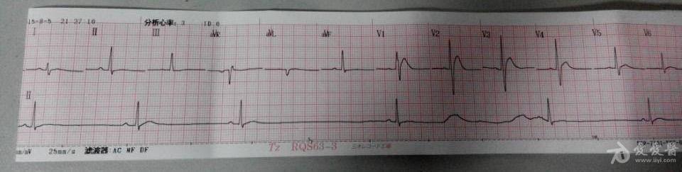 肺癌的病人 临终心电图