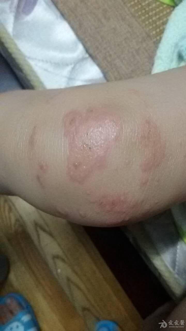 环状肉芽肿 还是多型红斑 谢谢大家