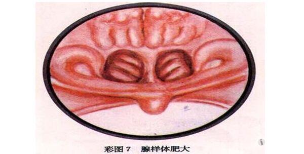 解剖基础15咽扁桃体