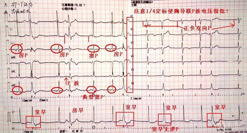 大家帮忙看看心电图
