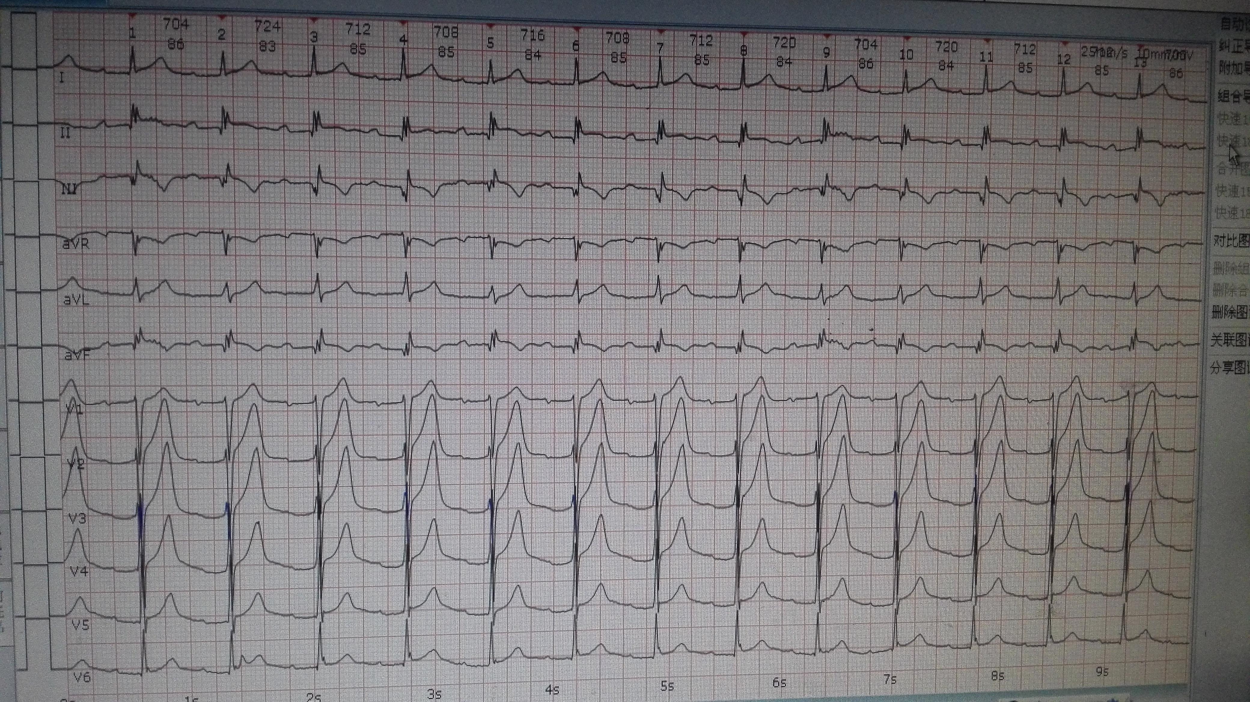 这是房颤心电图吗?