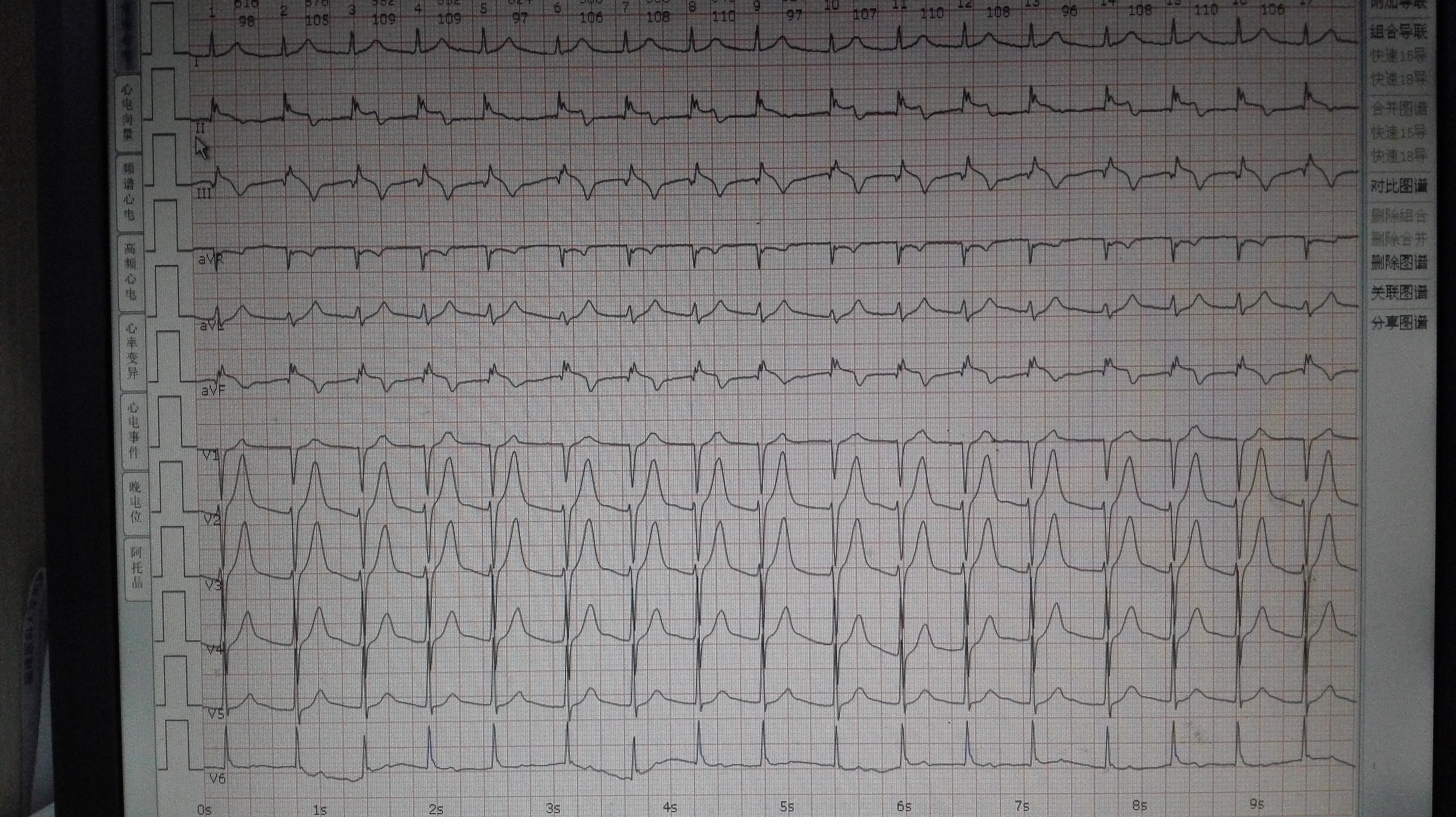 这是房颤心电图吗?