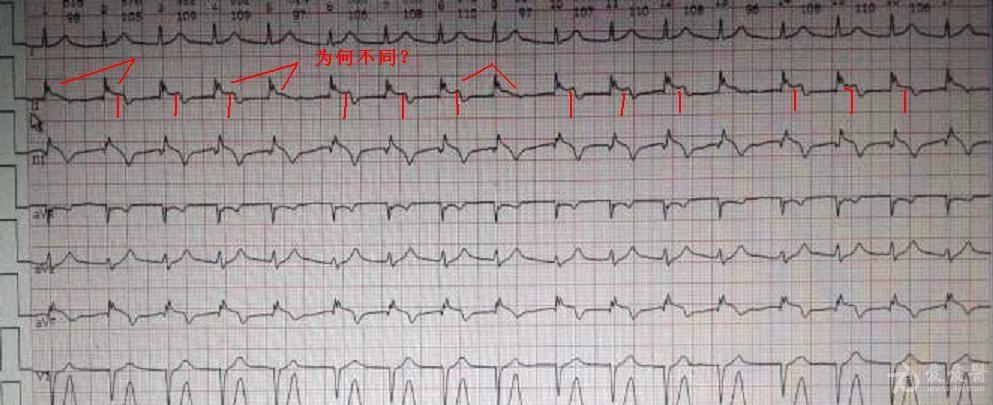 这是房颤心电图吗