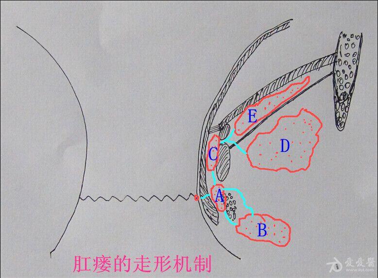 我的肛瘘分类