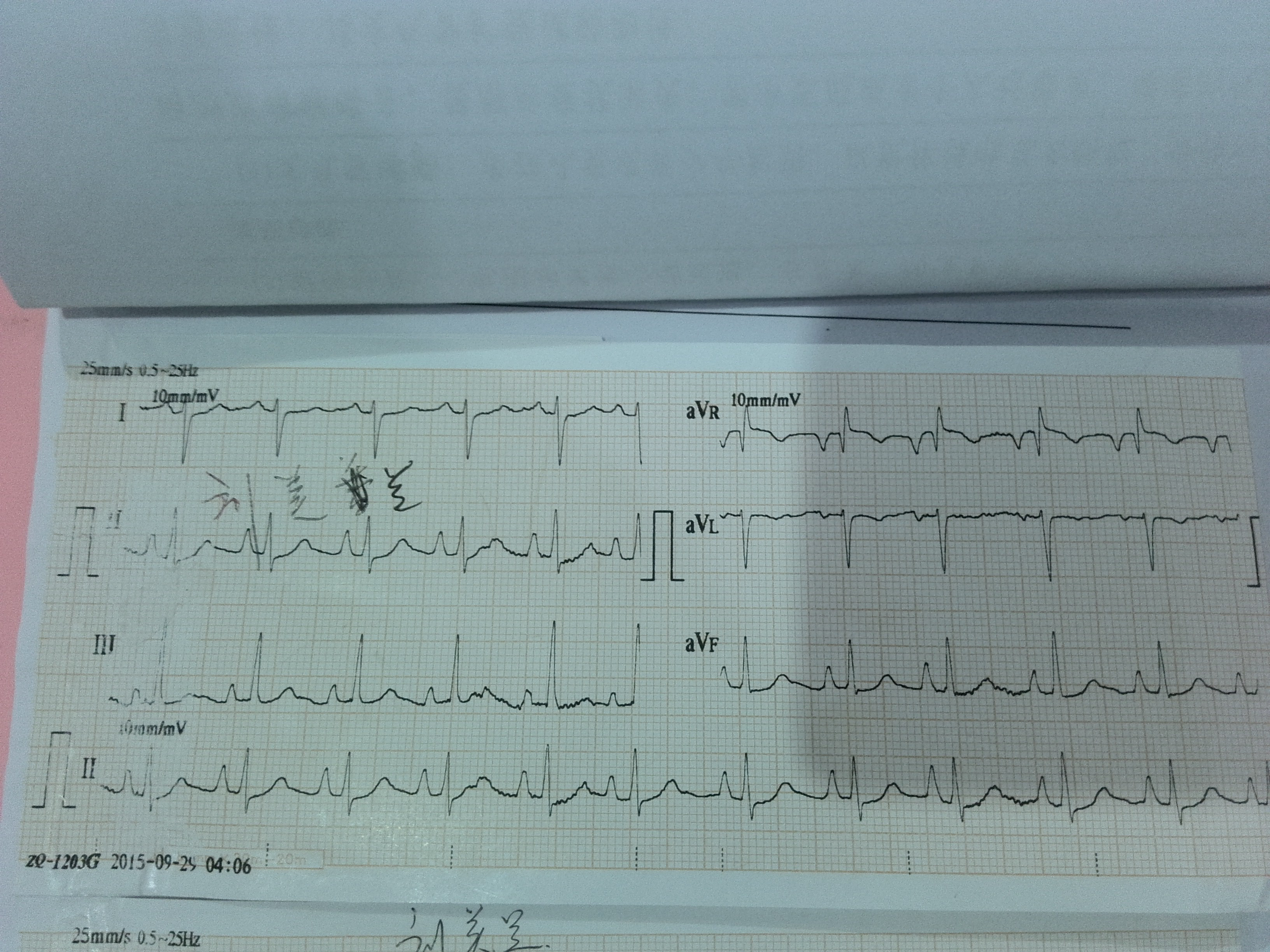 这份心电图是不是有鱼钩样改变