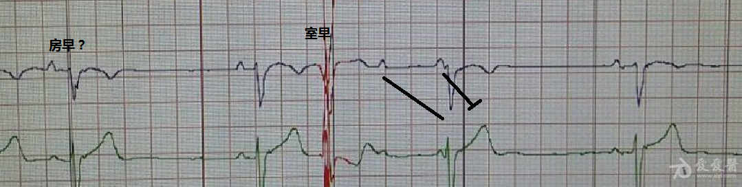 房室结双径路? - 心电图脑电图专业讨论版 - 爱爱医