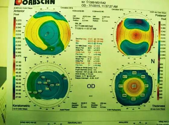 根据飞秒术后角膜地形图能判断手术有没有偏心切削吗怎么判断