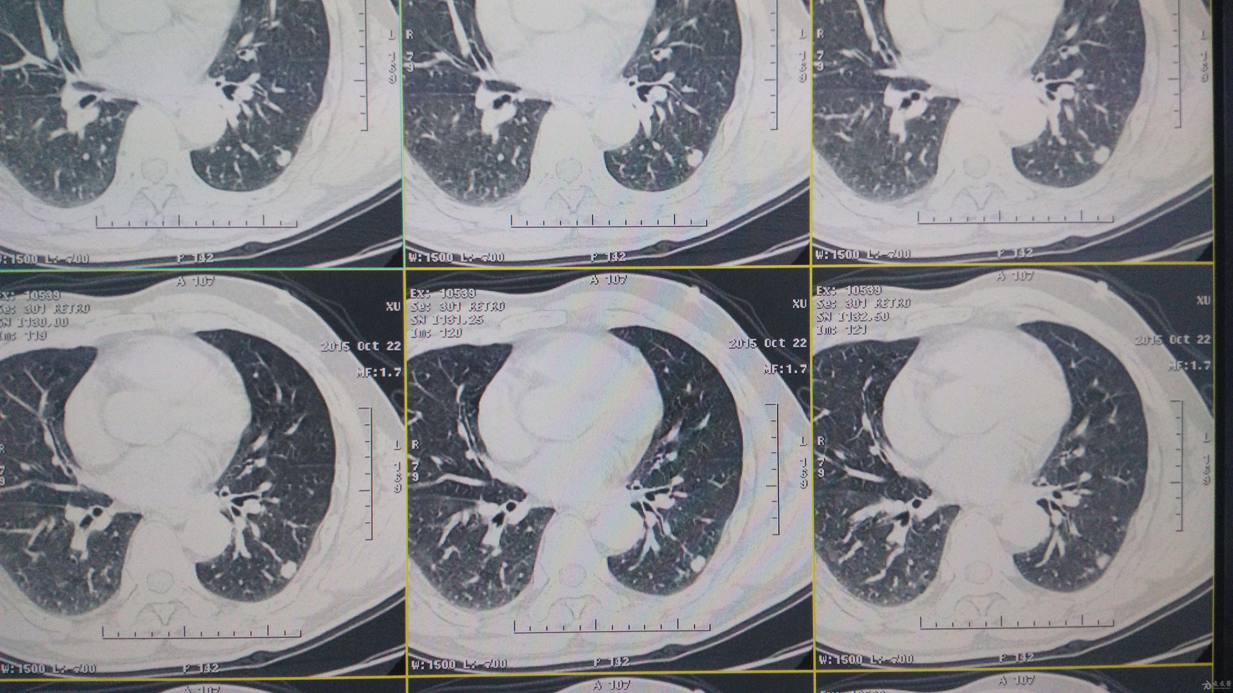 左肺下叶小结节性质重发大量原图
