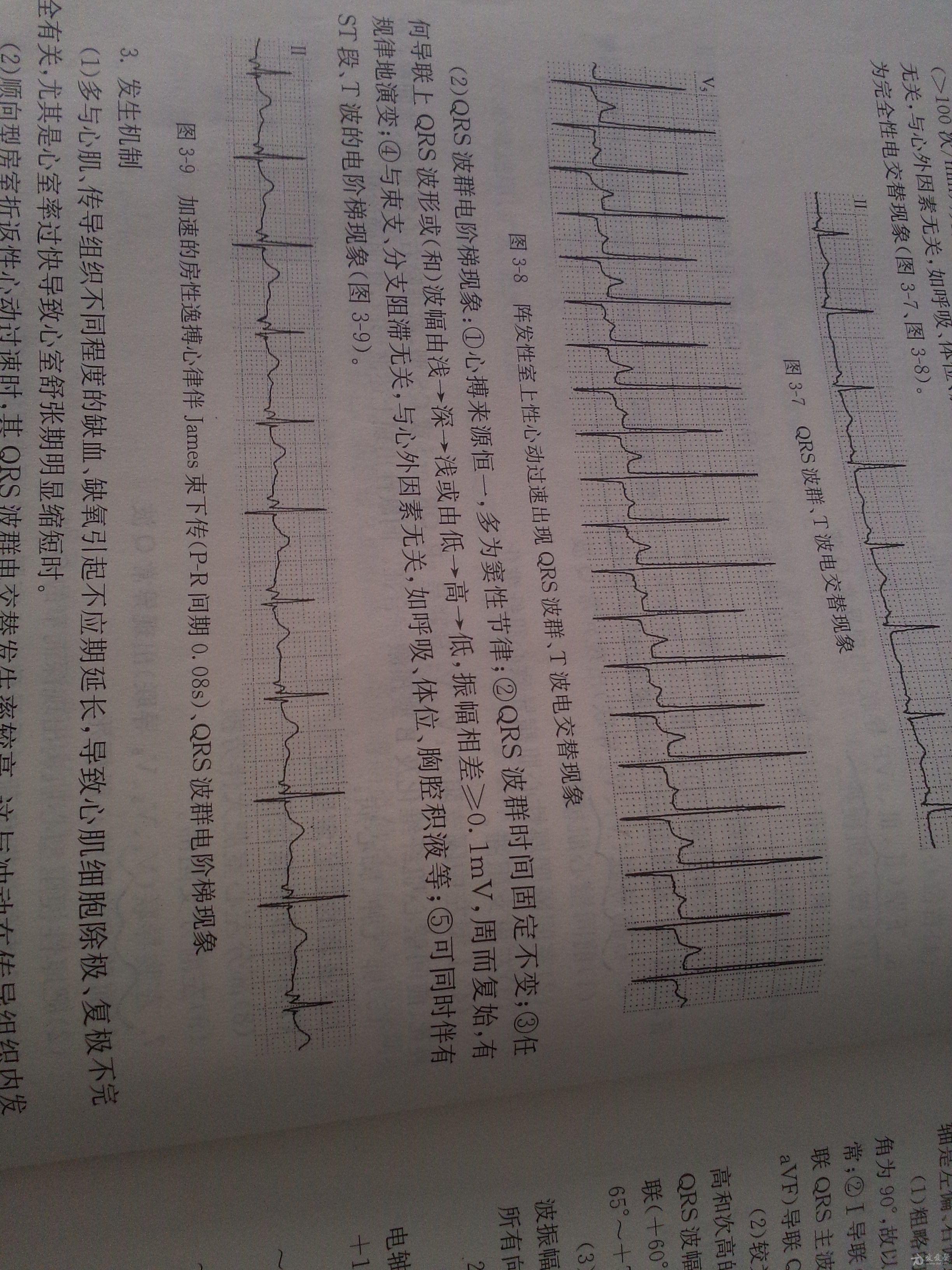 冬秋心电图讨论20151023注意肢体导联qrs波变化