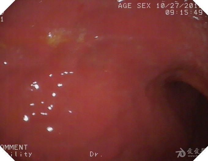 胃镜图片诊断