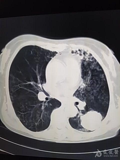 左肺下叶占位性病变,增强ct检查 医学影像学讨论版 爱爱医医学