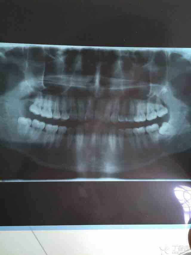 该智齿如何拔出,附全景 - 口腔医学专业讨论版 - 爱爱医医学论坛