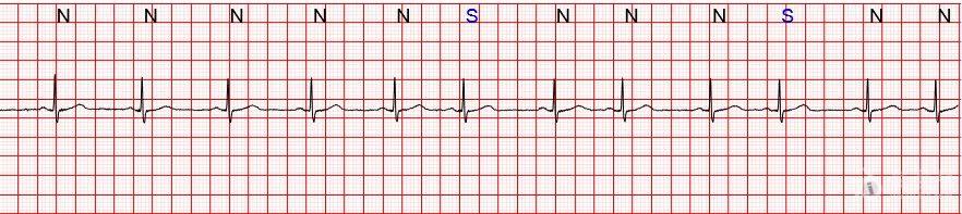请老师看看单导联连续测量截取的片段 - 心电图脑电图专业讨论版
