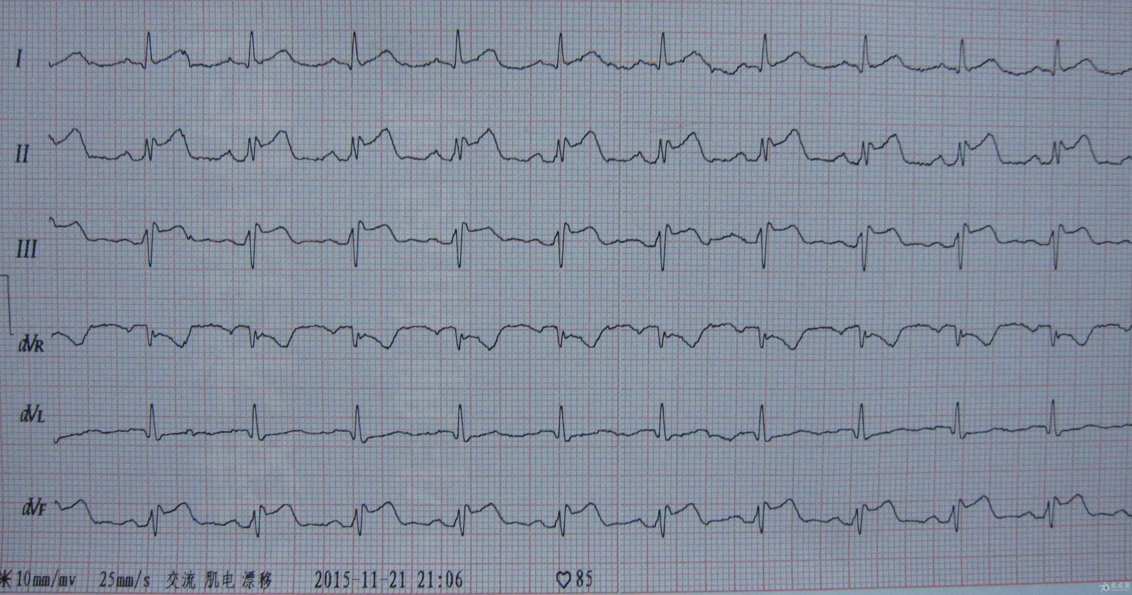 男性,50岁阵发性心绞痛2小时 心电图脑电图专业讨论版 爱爱医医学