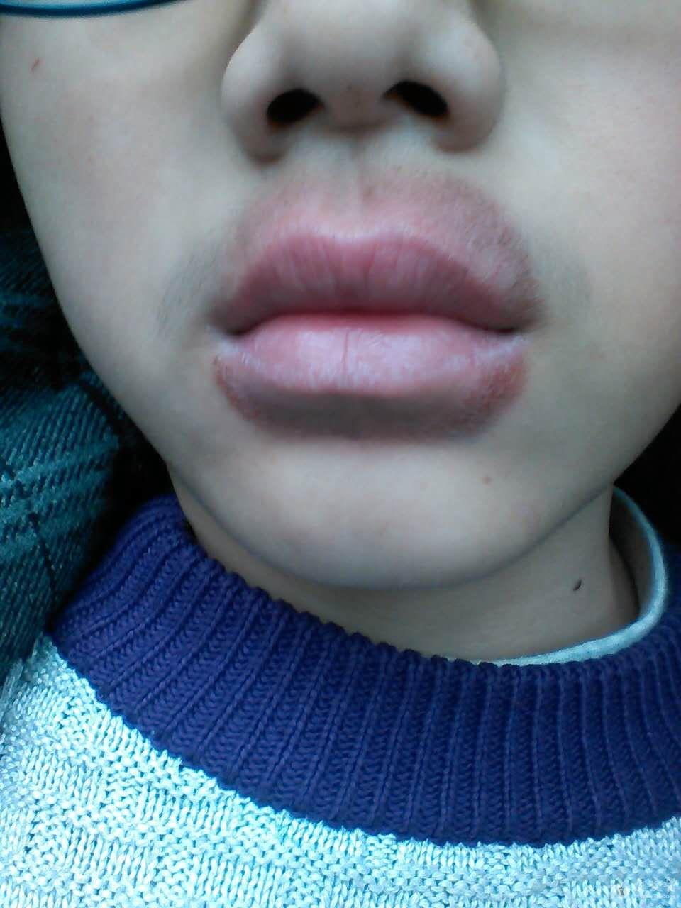 嘴唇周围一圈红色的斑疹,不痒,求助