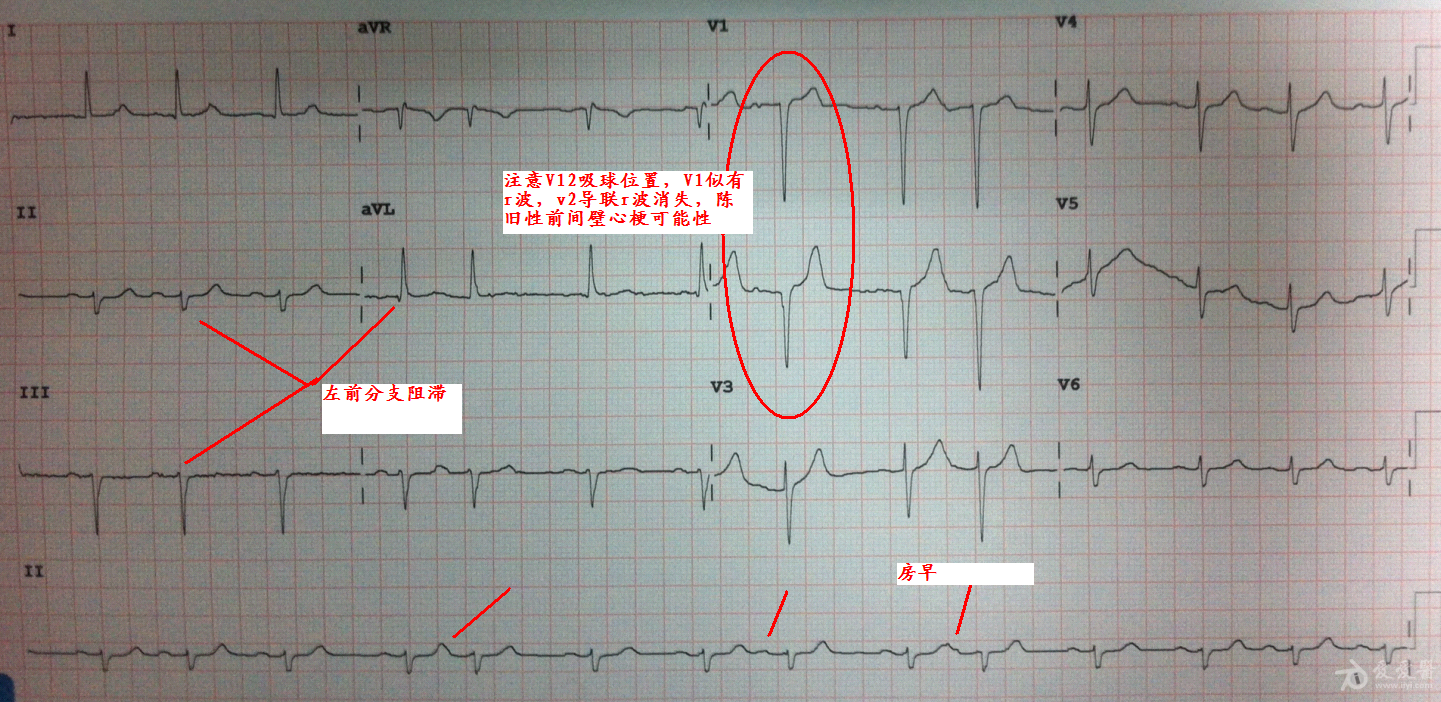 r波异常减低? - 心电图脑电图专业讨论版 - 爱爱医