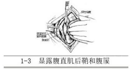 图解| 腹壁切口疝修复术