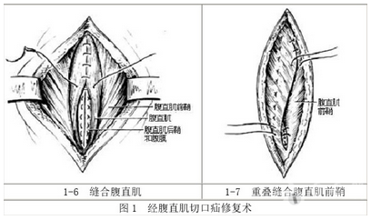 图解| 腹壁切口疝修复术