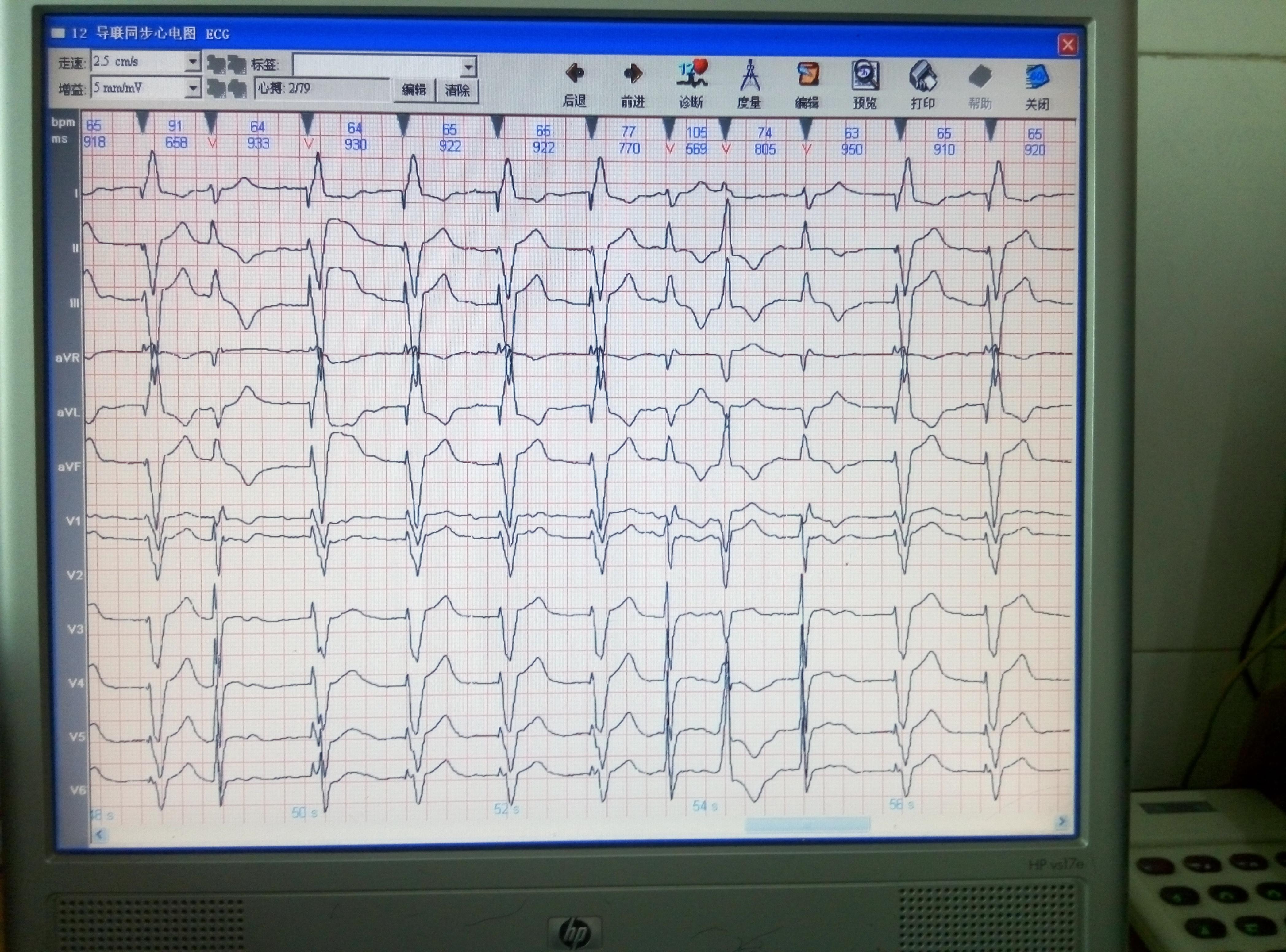 起搏器心电图