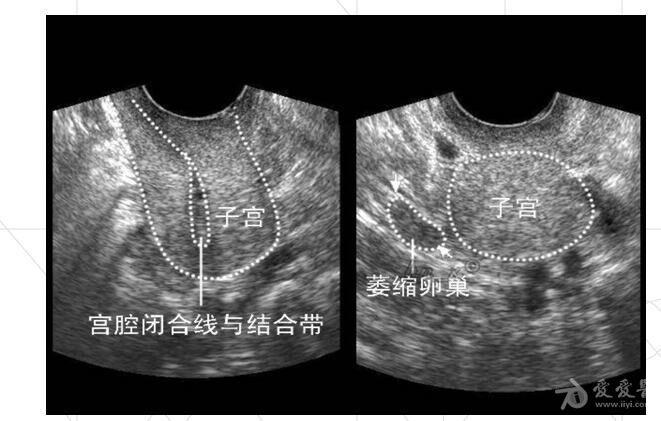 子宫附件的超声图片