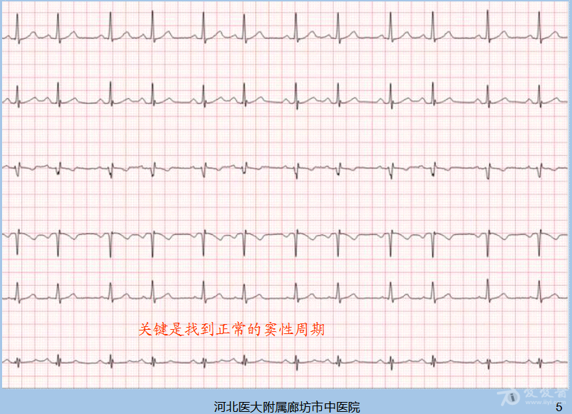此图可诊断窦性早搏二联律吗? - 心电图脑电图专业版