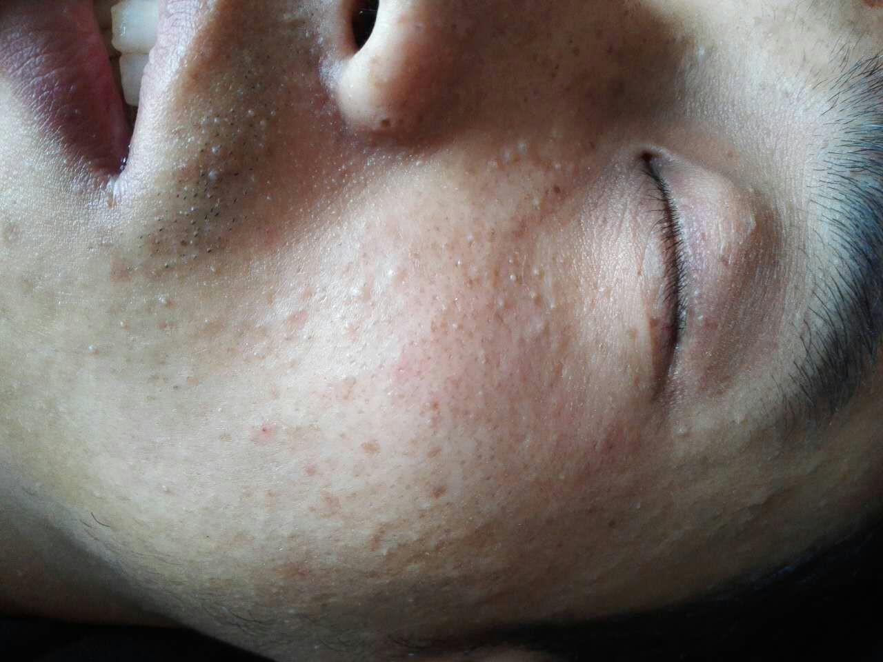 面部丘疹6年全脸散在皮色丘疹类似闭合性粉刺但没有内容物右侧眉毛