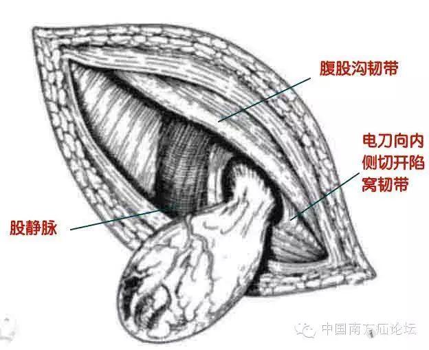 【转帖】再谈股疝