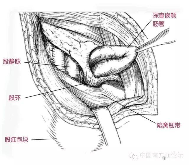 【转帖】再谈股疝