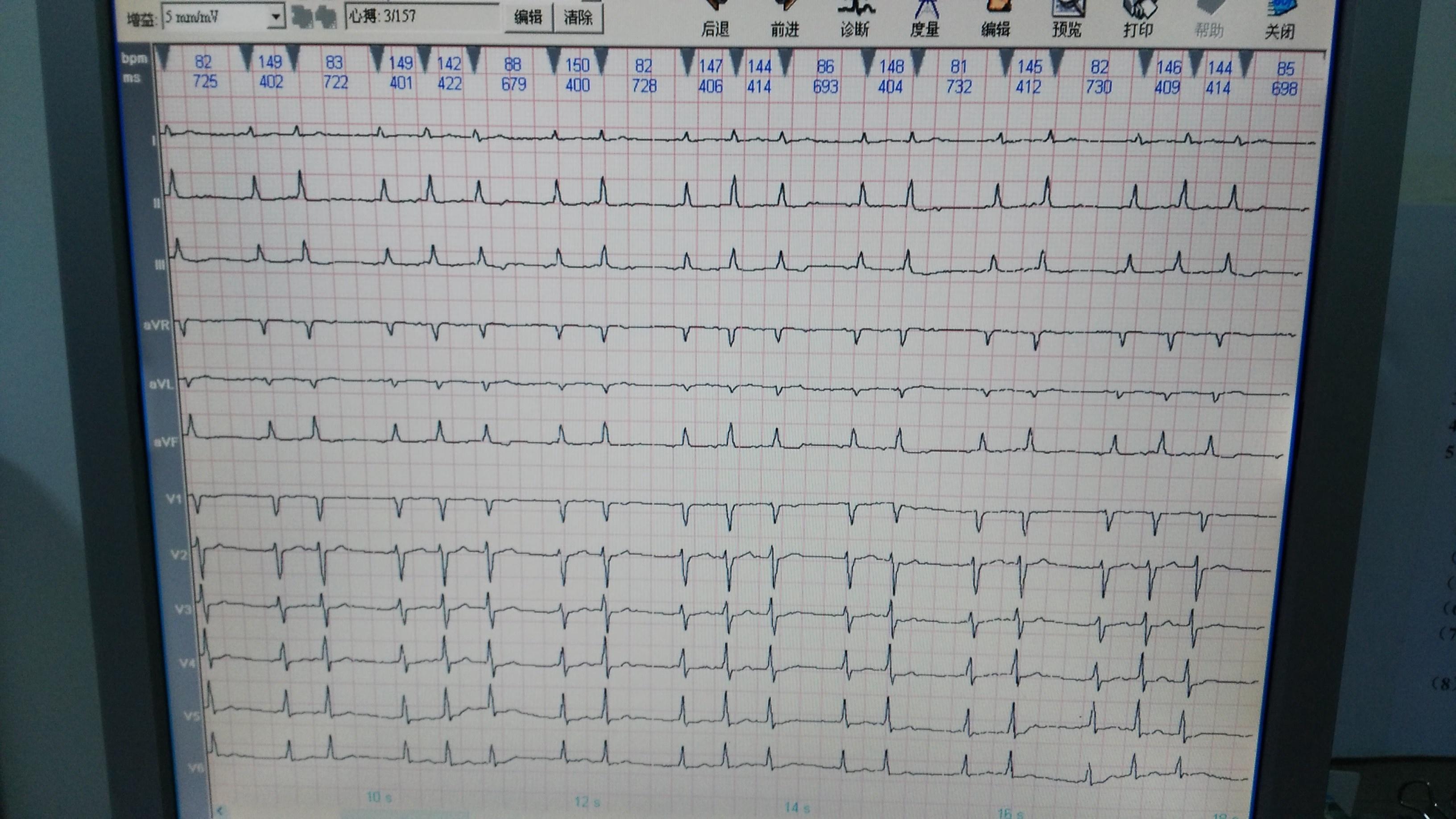 是房性心动过速吗? - 心电图脑电图专业讨论版 - 爱爱医医学论坛