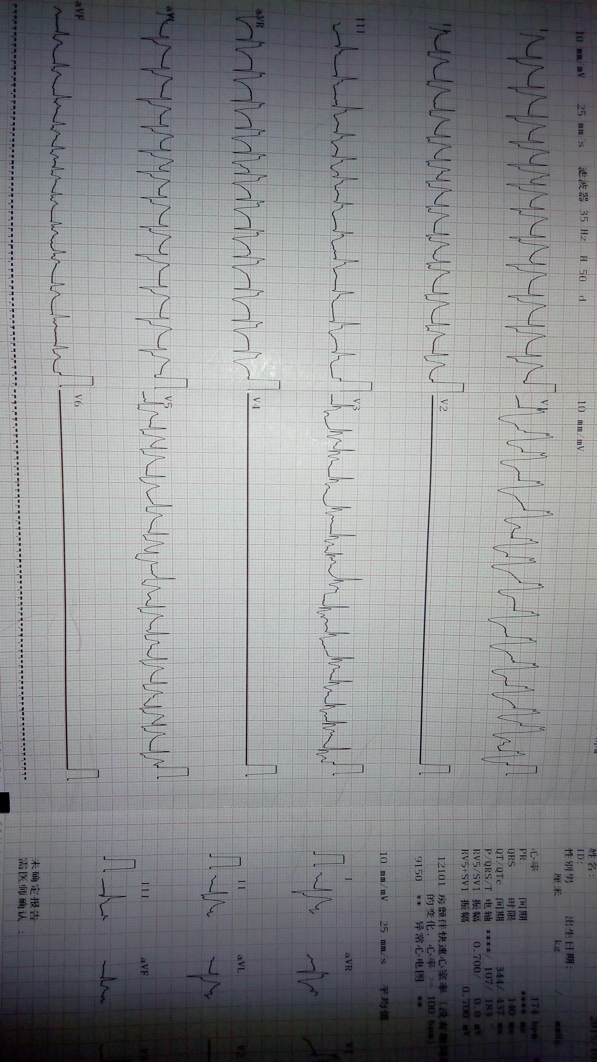 临终前心电图请大侠们帮忙分析