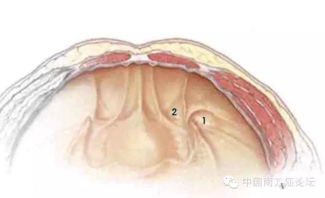 腔镜下腹股沟疝的解剖一