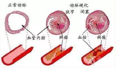 以男性多见,多发生于有吸烟史,合并高血压病,冠状动脉粥样硬化性心脏