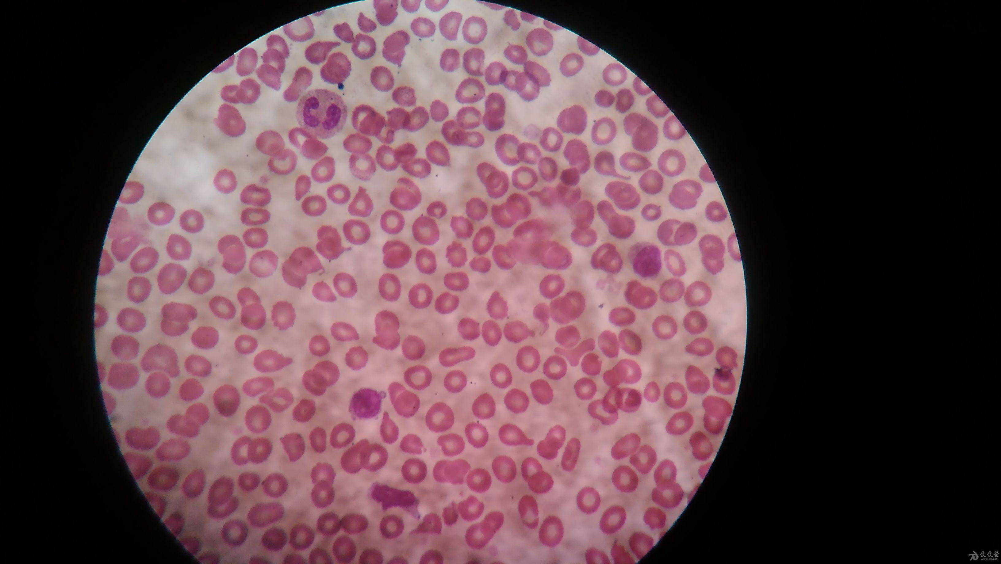 学涂片请教,下面血涂片有原始细胞吗 血液与风湿免疫专业讨论版